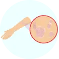 Autoimmune Disorders